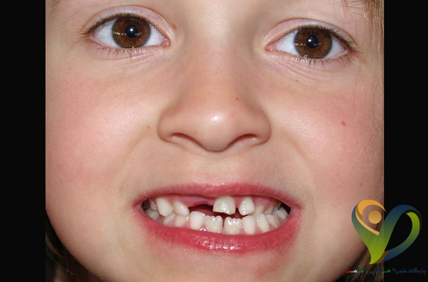  هر آنچه که باید درباره دندان شیری بدانیم!